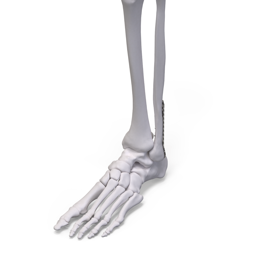 Placas Para Fíbula Distal