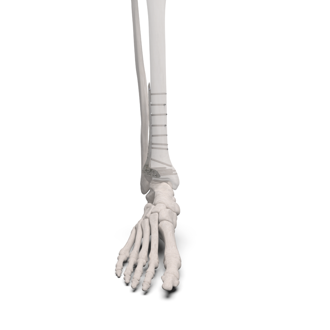 Placas para Tíbia Distal